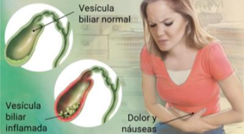 Colecistectomía laparoscópica o abierta - Misava